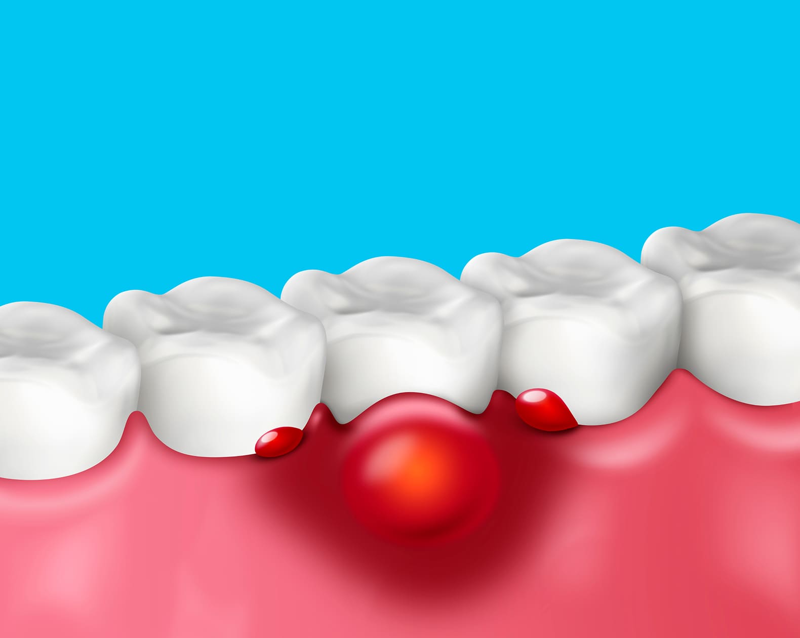 periodontal